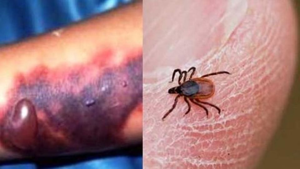 راههای پیشگیری از بیماری تب کریمه کنگو (CCHF)