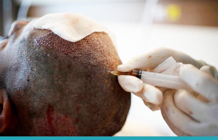 آشنایی با مراقبت های لازم قبل از کاشت مو