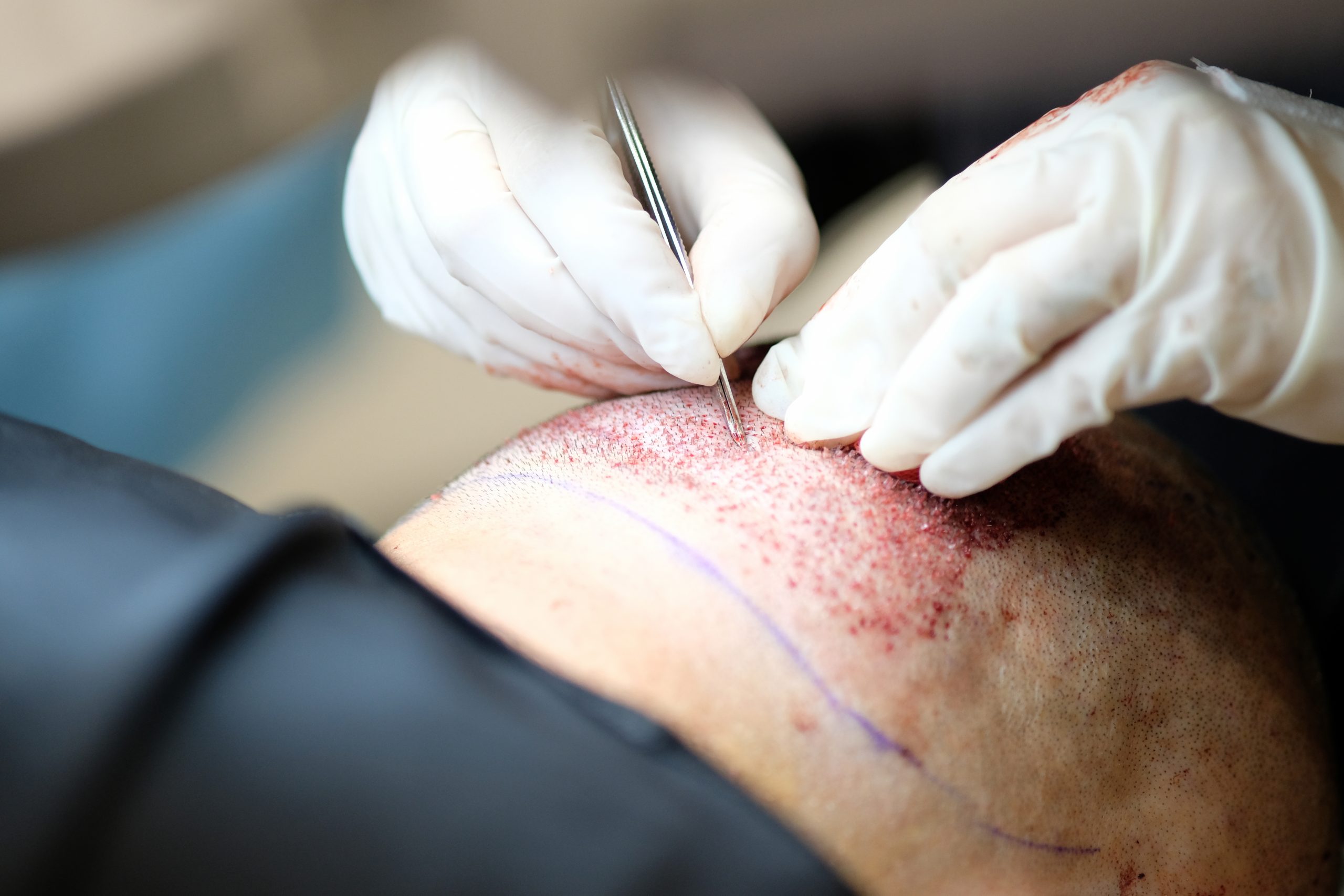 آشنایی با مراحل کاشت مو طبیعی آشنایی با مراحل کاشت مو طبیعی