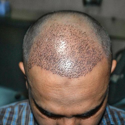 سن مناسب برای کاشت موی طبیعی سن مناسب برای کاشت موی طبیعی