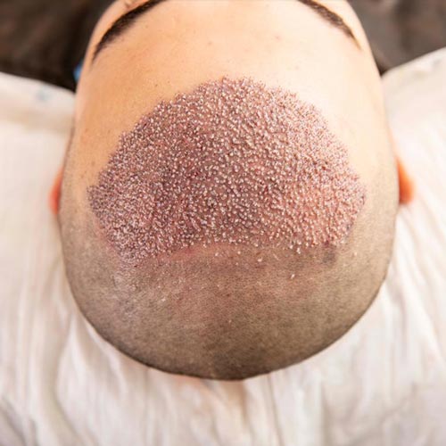 سن مناسب برای کاشت موی طبیعی سن مناسب برای کاشت موی طبیعی